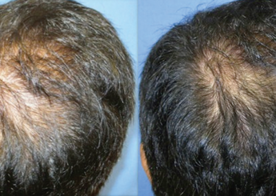 DERMAPEN - Zdjecia przed i po - leczenie lysienia 01